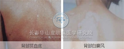 对此长春华山皮肤病医学研究院的主任医师刘志军指出,身上有白斑的